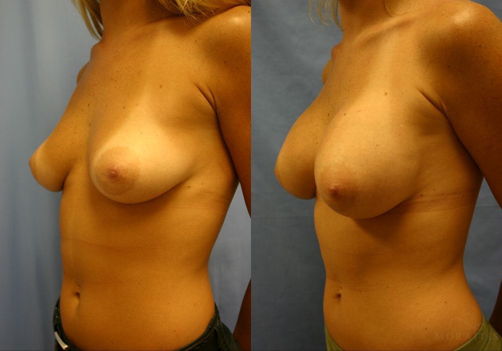 Breast Augmentation - Thumbnail 2