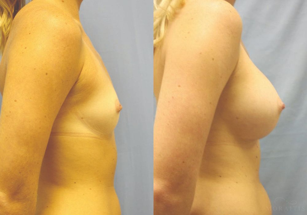 Breast Augmentation - Thumbnail 3