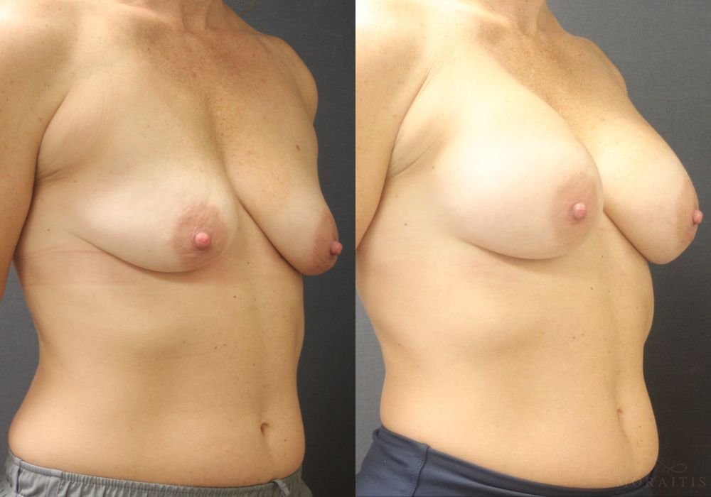 Breast Augmentation - Thumbnail 2