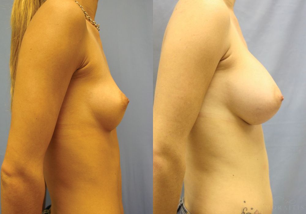 Breast Augmentation - Thumbnail 3