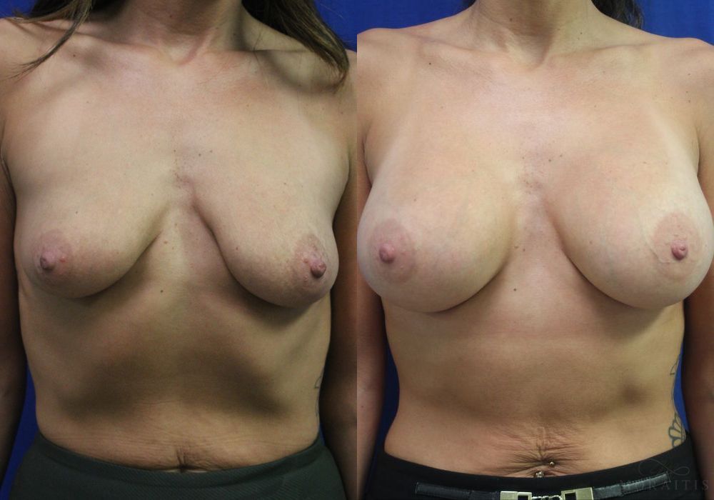 Breast Augmentation - Case 15413