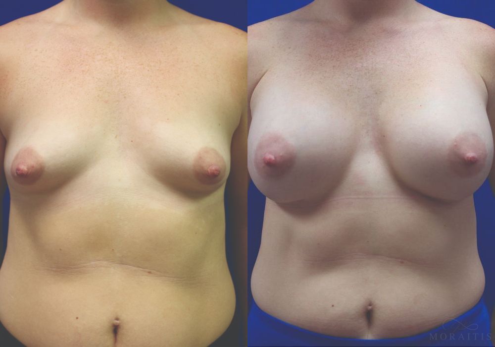 Breast Augmentation - Case 15516