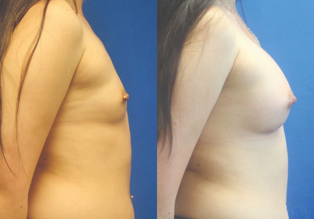 Breast Augmentation - Thumbnail 3