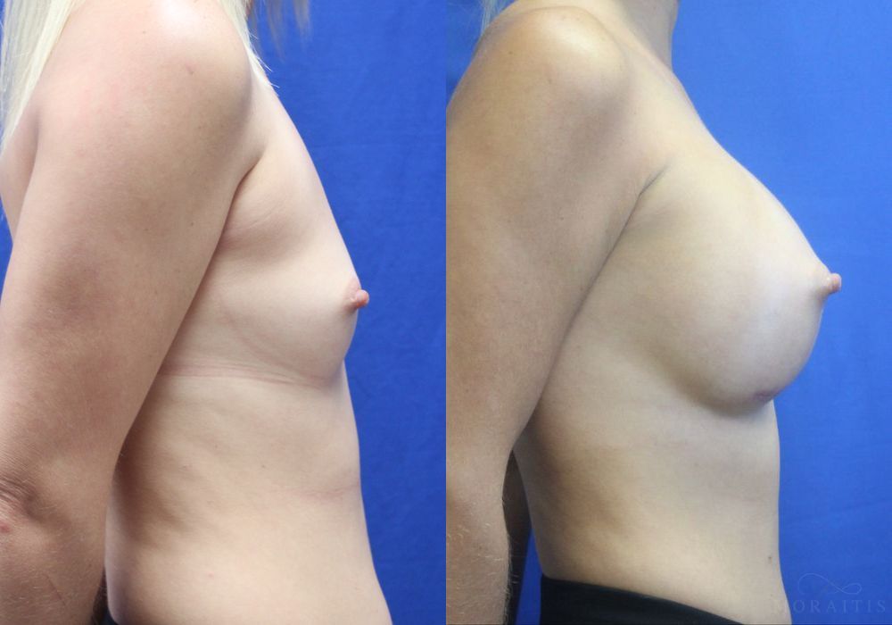 Breast Augmentation - Thumbnail 3