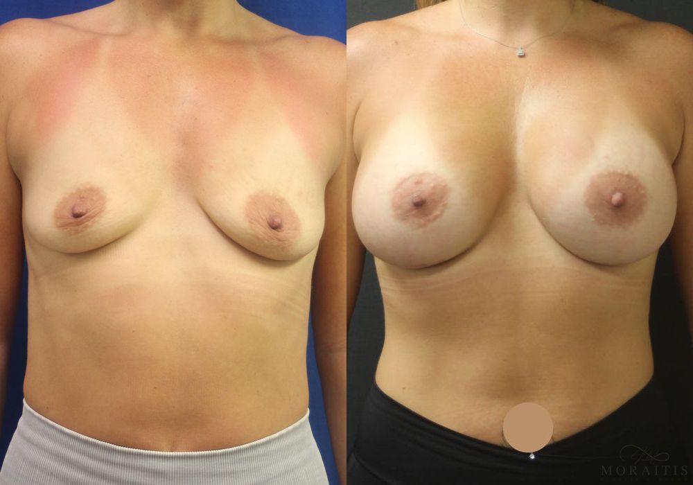 Breast Augmentation - Case 15406