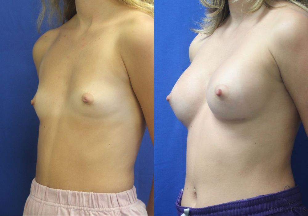 Breast Augmentation - Thumbnail 2