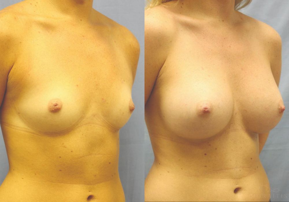 Breast Augmentation - Thumbnail 2