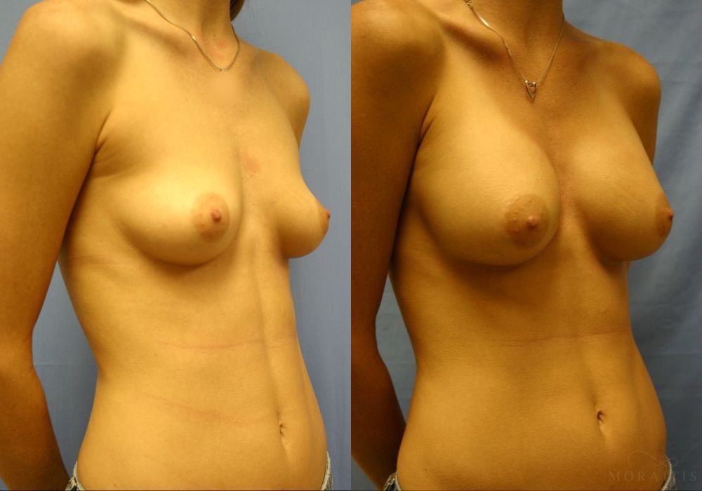 Breast Augmentation - Thumbnail 2