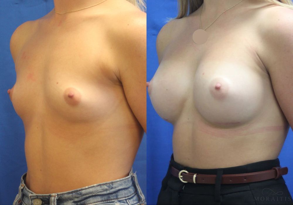 Breast Augmentation - Thumbnail 2