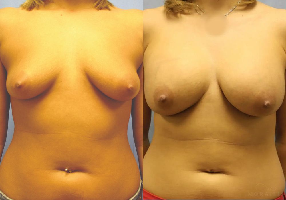 Breast Augmentation - Case 15383