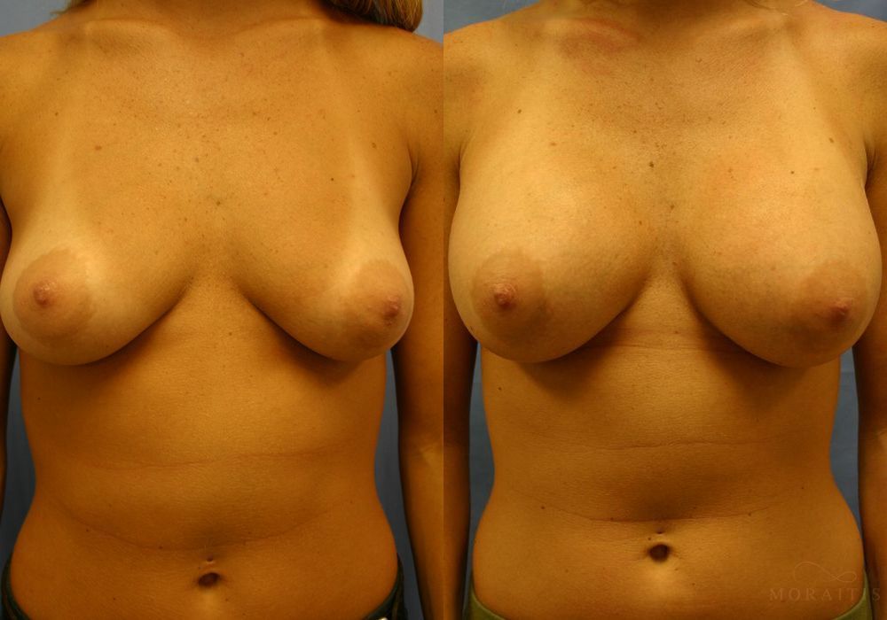 Breast Augmentation - Case 16030