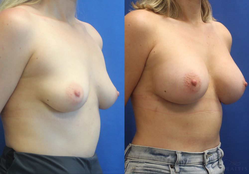 Breast Augmentation - Thumbnail 2