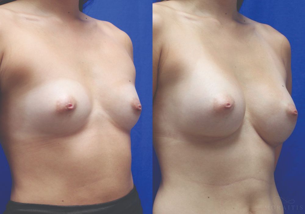 Breast Augmentation - Thumbnail 2