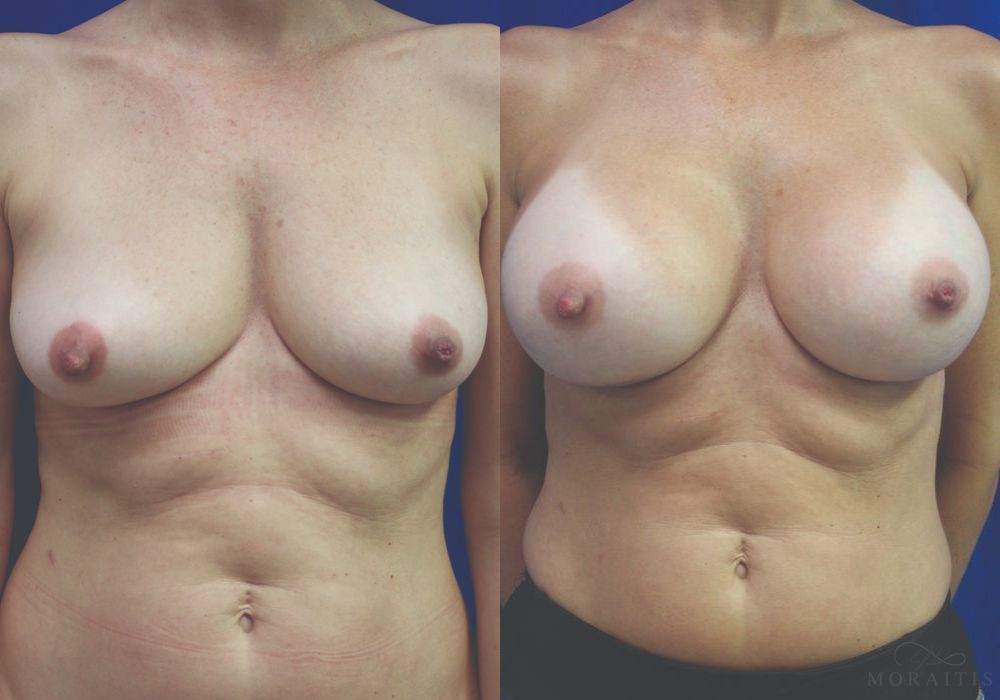 Breast Augmentation - Case 15392