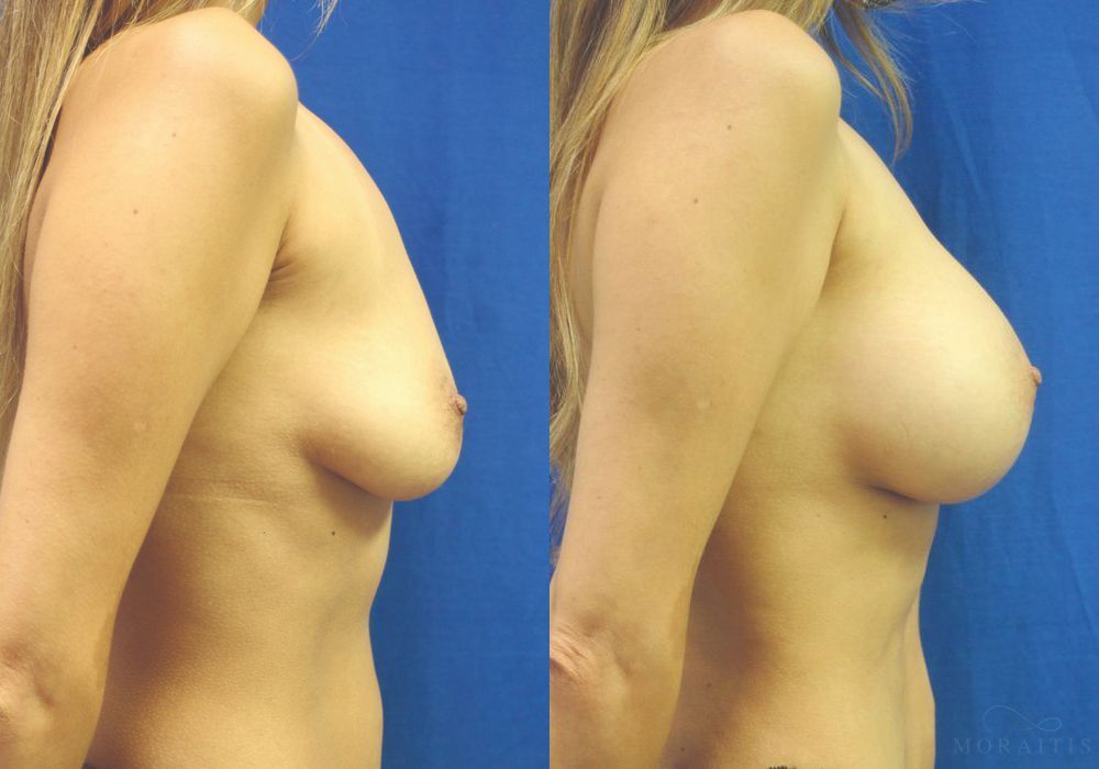 Breast Augmentation - Thumbnail 3