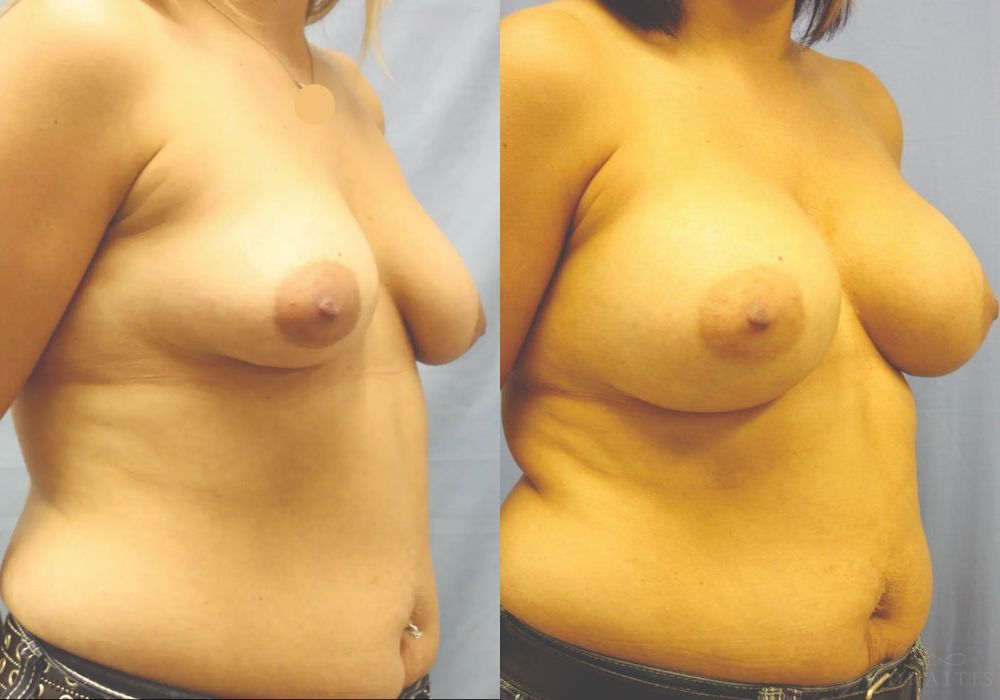 Breast Augmentation - Thumbnail 2