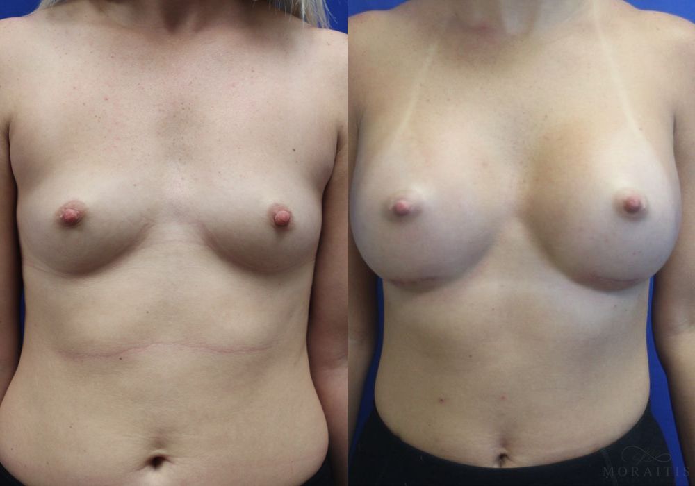 Breast Augmentation - Case 15379
