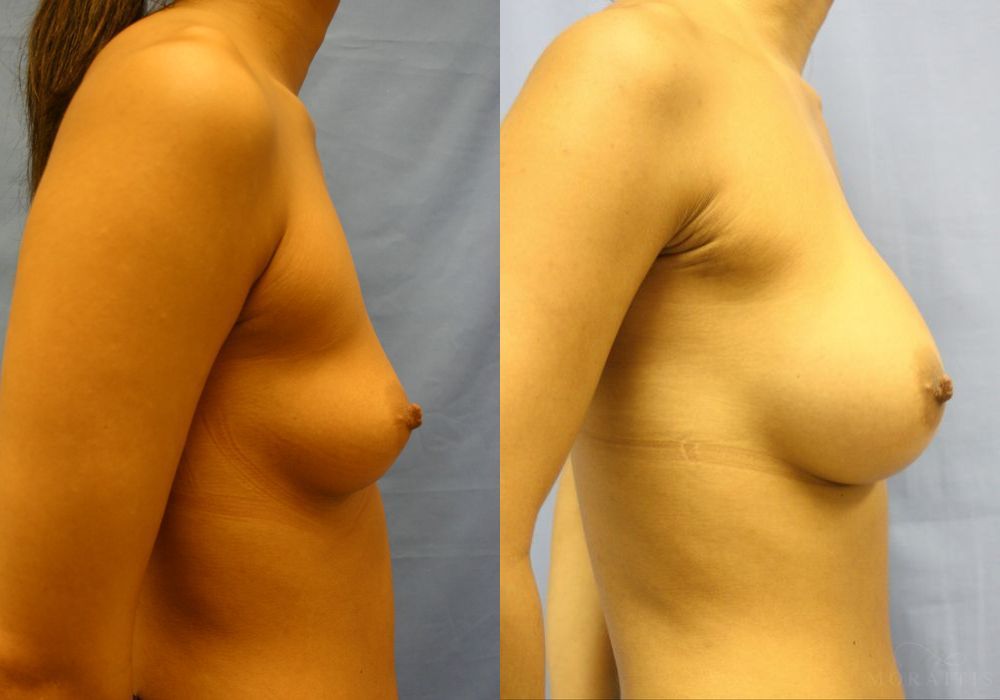 Breast Augmentation - Thumbnail 3