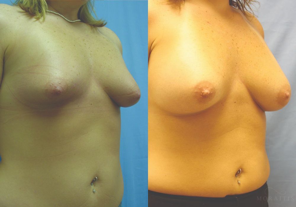 Breast Augmentation - Thumbnail 2