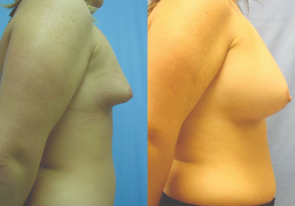 Breast Augmentation - Thumbnail 3