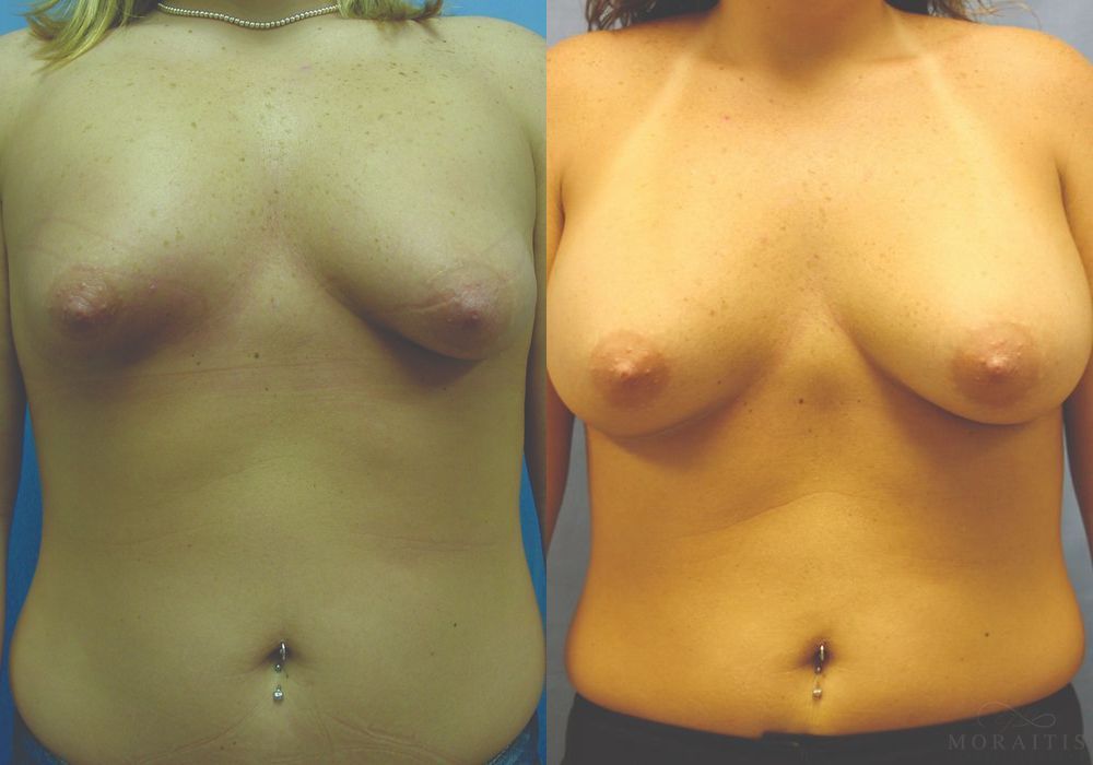 Breast Augmentation - Case 15517