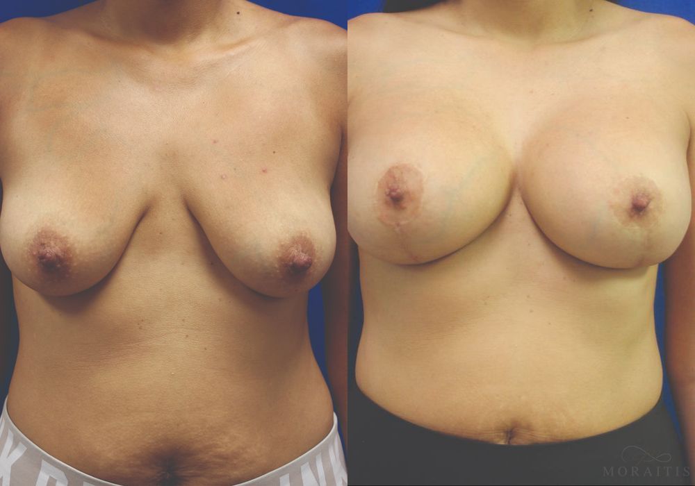 Breast Augmentation with Lift - Case 15416