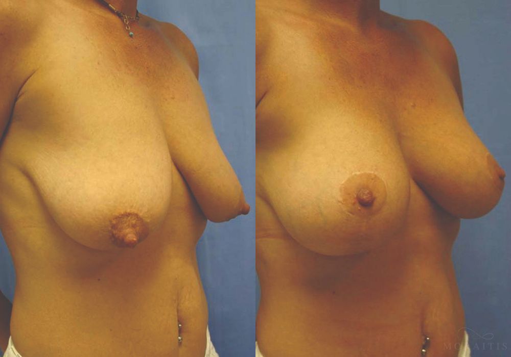 Breast Augmentation with Lift - Thumbnail 2
