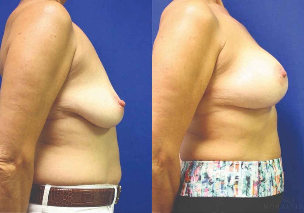 Breast Augmentation with Lift - Thumbnail 3