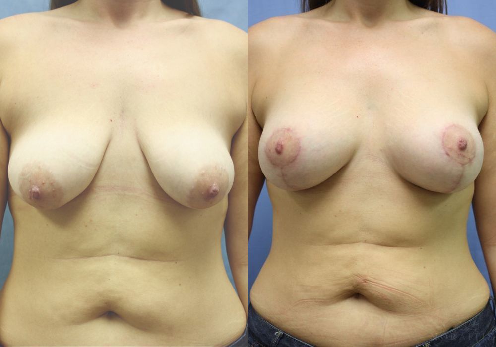 Breast Augmentation with Lift - Case 15420