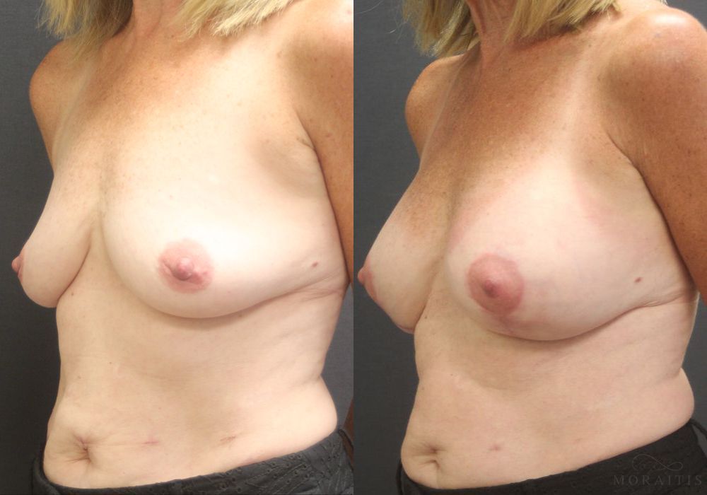 Breast Augmentation with Lift - Thumbnail 2