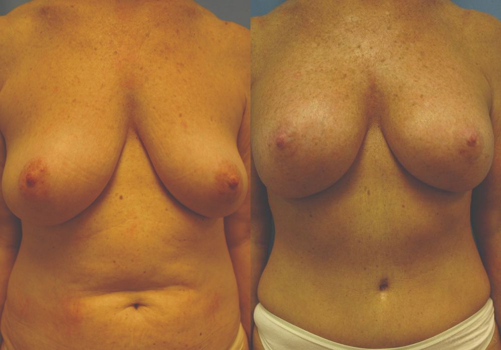 Breast Augmentation with Lift - Case 15419