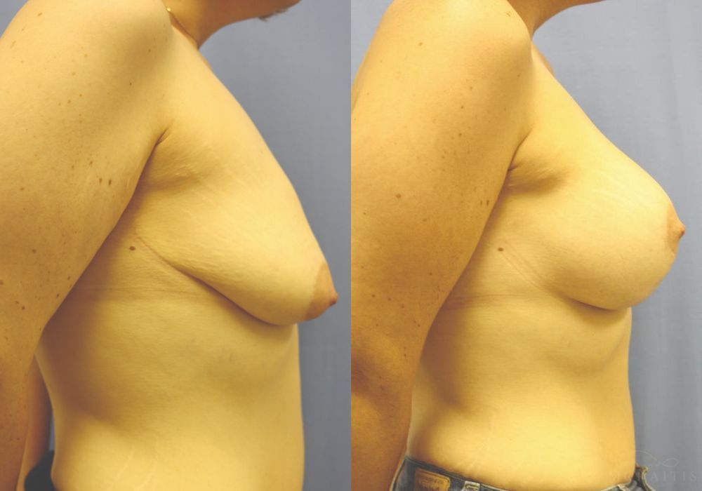 Breast Augmentation with Lift - Thumbnail 3