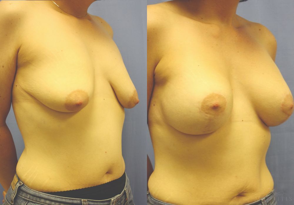 Breast Augmentation with Lift - Thumbnail 2