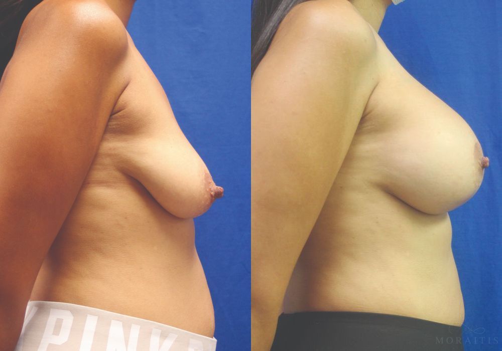 Breast Augmentation with Lift - Thumbnail 3