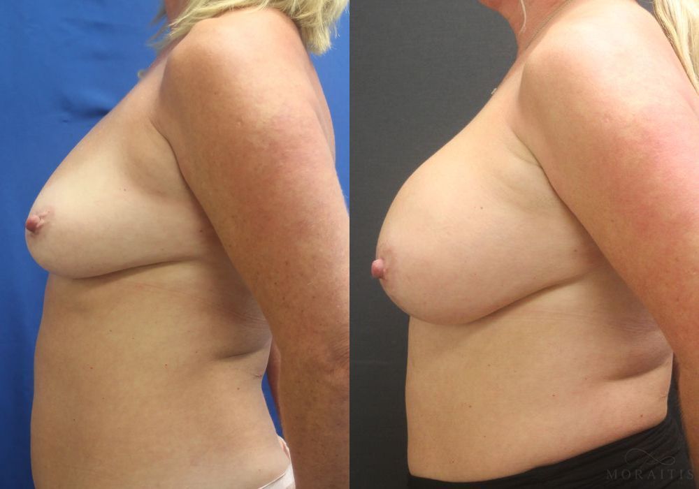 Breast Augmentation with Lift - Thumbnail 3