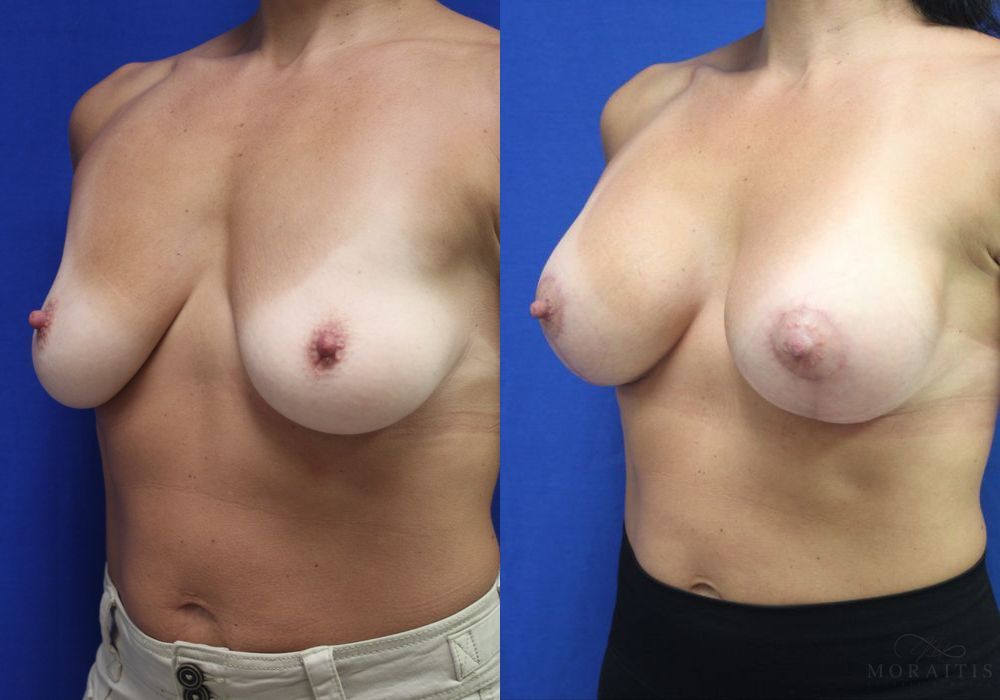 Breast Augmentation with Lift - Thumbnail 2