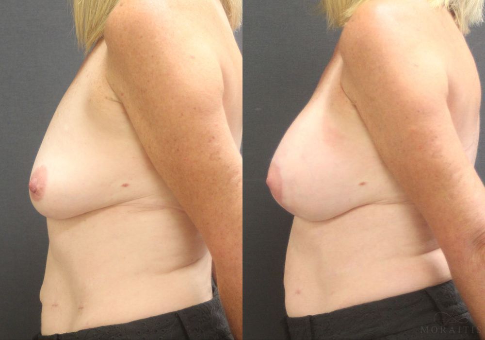 Breast Augmentation with Lift - Thumbnail 3