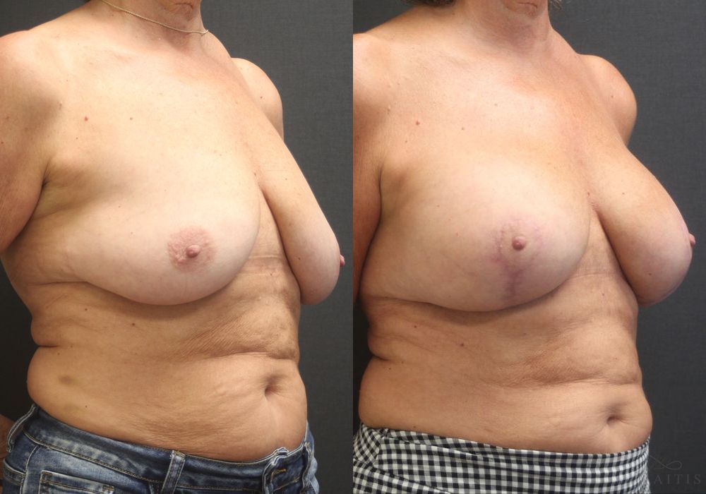 Breast Augmentation with Lift - Thumbnail 2