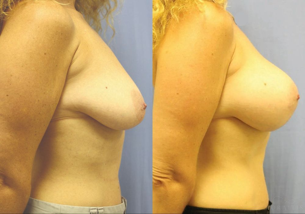 Breast Augmentation with Lift - Thumbnail 3