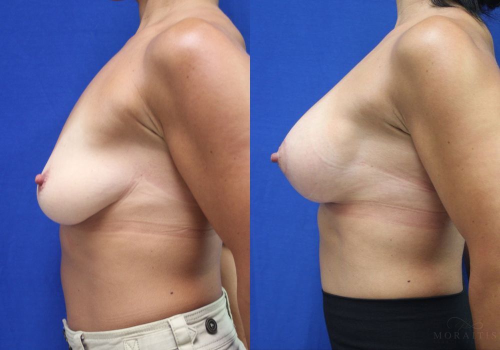 Breast Augmentation with Lift - Thumbnail 3