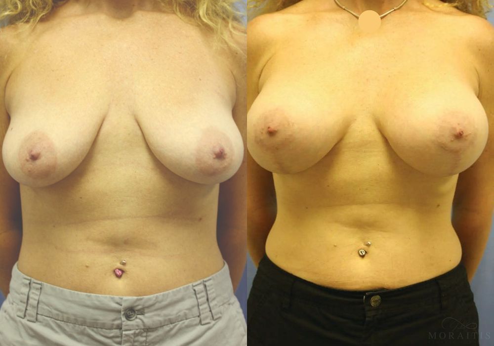 Breast Augmentation with Lift - Case 15522