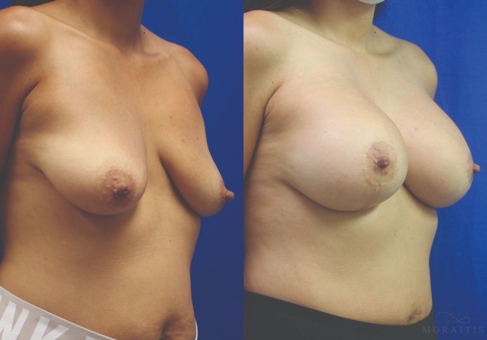 Breast Augmentation with Lift - Thumbnail 2