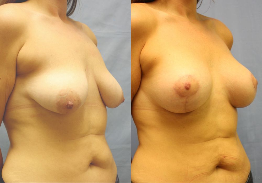 Breast Augmentation with Lift - Thumbnail 2