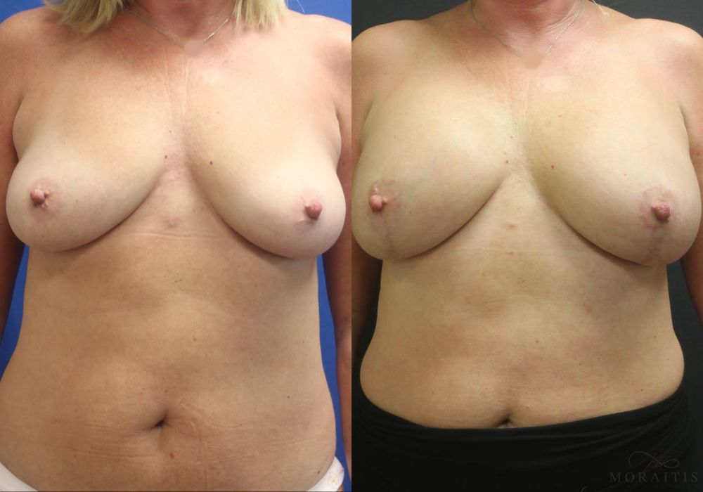 Breast Augmentation with Lift - Case 15423