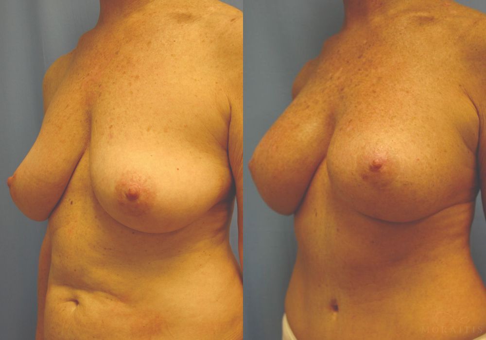 Breast Augmentation with Lift - Thumbnail 2