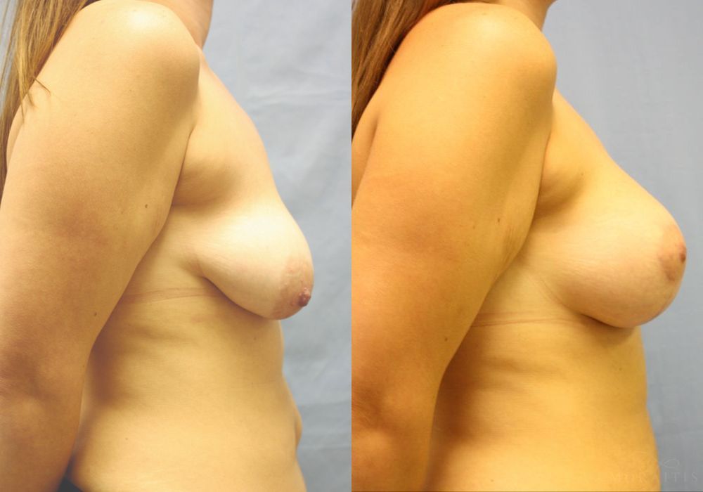 Breast Augmentation with Lift - Thumbnail 3