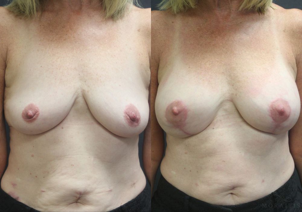 Breast Augmentation with Lift - Case 15415