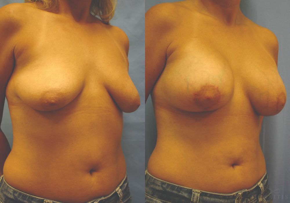 Breast Augmentation with Lift - Thumbnail 2
