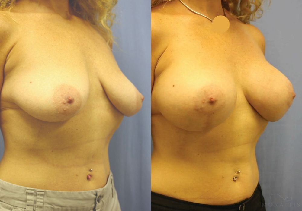 Breast Augmentation with Lift - Thumbnail 2
