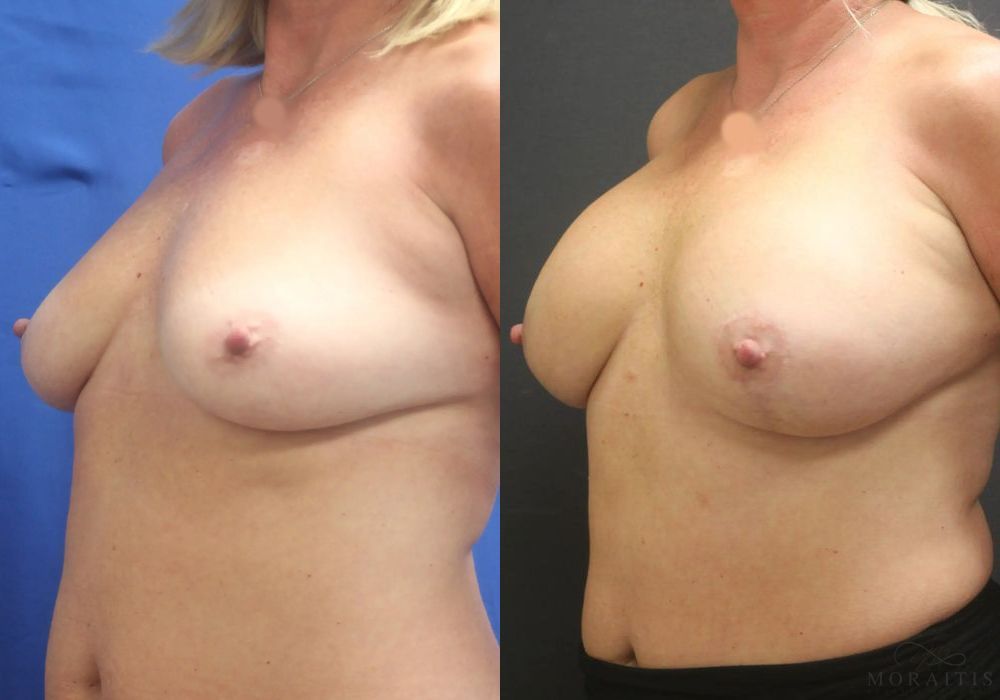 Breast Augmentation with Lift - Thumbnail 2